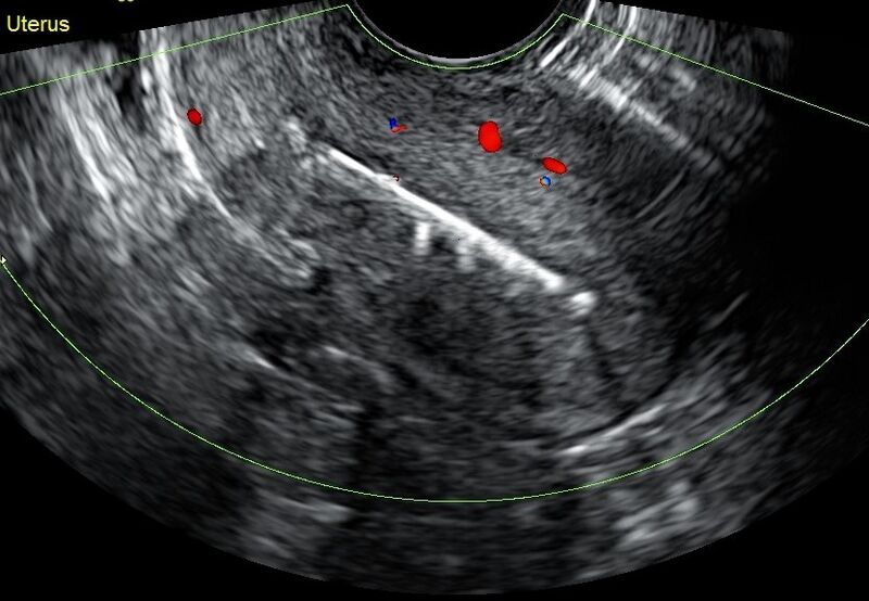 File:Calcifications associated with the intrauterine device (Radiopaedia 84291-99580 C 1).jpg