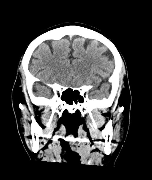 File:Calcified meningioma (Radiopaedia 74361-85243 Coronal non-contrast 16).jpg