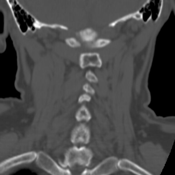 File:Calcified meningioma - cervical canal (Radiopaedia 70136-80171 Coronal bone window 27).jpg