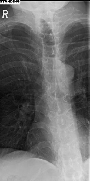 File:Camptocormia (bent spine syndrome) (Radiopaedia 46104-50456 Frontal 1).JPG
