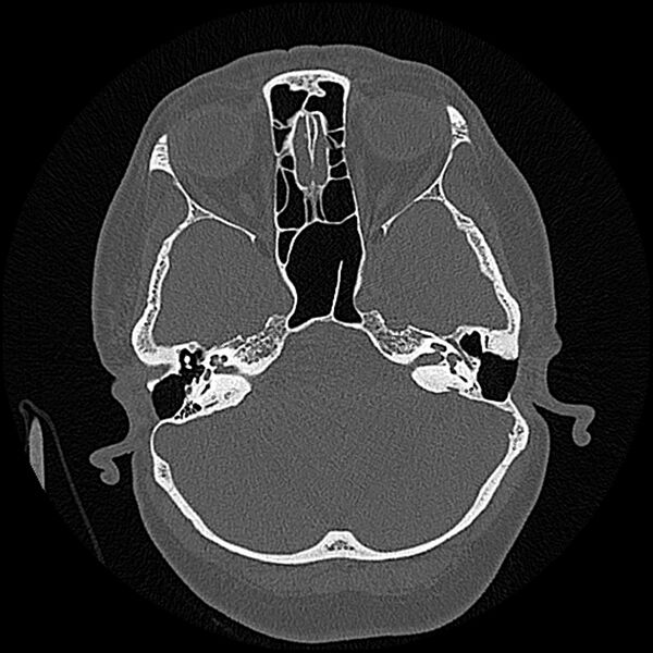 File:Canal up mastoidectomy (Radiopaedia 78108-90638 Axial bone window 76).jpg