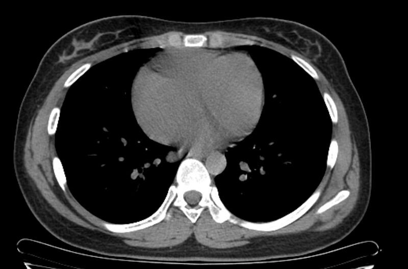 File:Cannonball metastases - uterine choriocarcinoma (Radiopaedia 70137-80173 Axial non-contrast 77).jpg