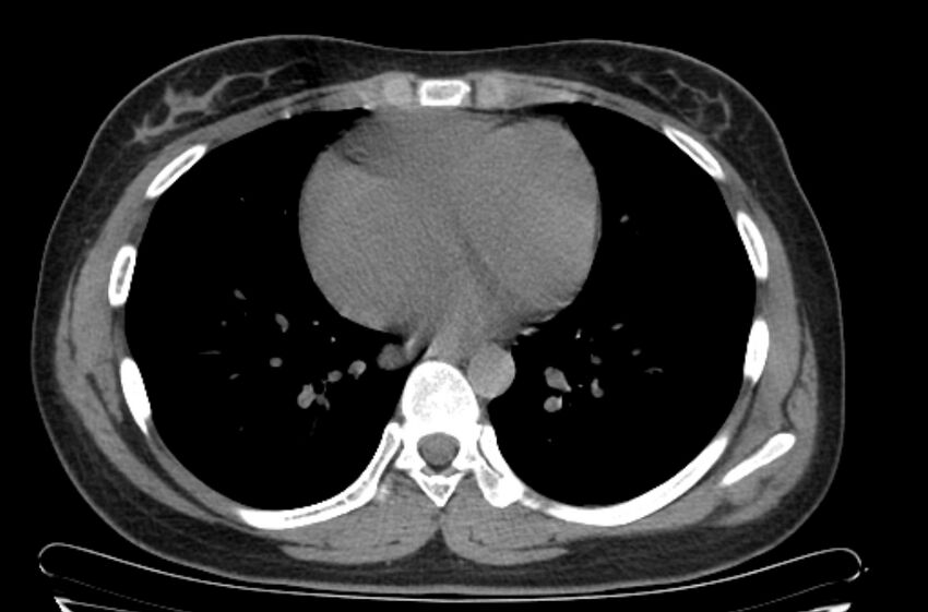 Cannonball metastases - uterine choriocarcinoma (Radiopaedia 70137-80173 Axial non-contrast 77).jpg
