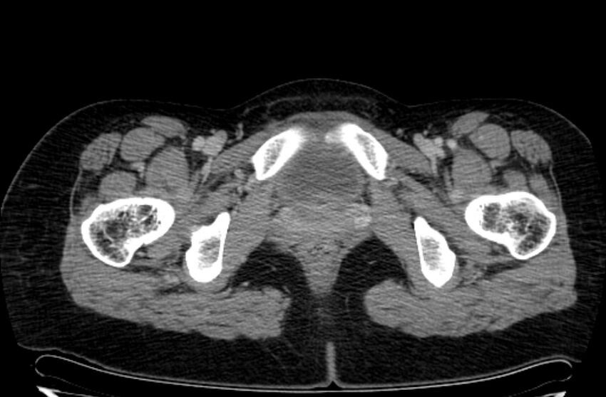 Cannonball metastases - uterine choriocarcinoma (Radiopaedia 70137-80174 A 61).jpg