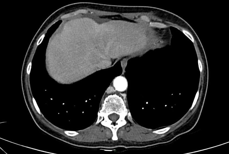 File:Carcinoid mesenteric tumor complicated by chylous ascites (Radiopaedia 76312-88926 A 7).jpg