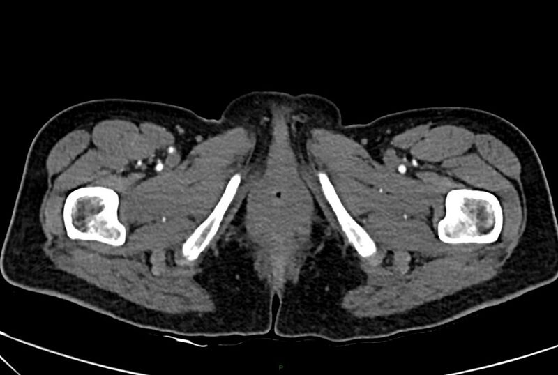 File:Carcinoid mesenteric tumor complicated by chylous ascites (Radiopaedia 76312-88926 A 86).jpg
