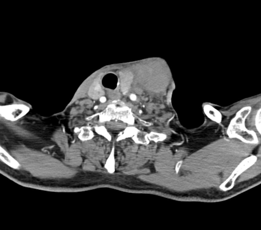 Carotid artery pseudoaneurysm (Radiopaedia 84030-99259 C 63).jpg