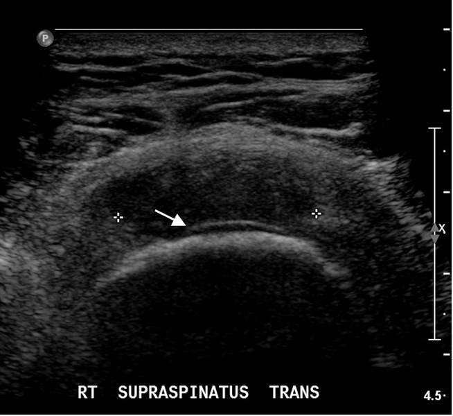 File:Cartilage interface sign - supraspinatus tear (Radiopaedia 14198-14055 A 1).png