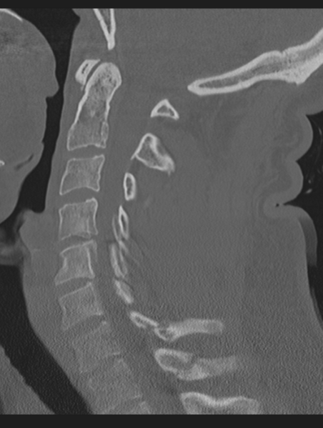 File:Cavernoma of cervical cord (Radiopaedia 50838-56346 Sagittal bone window 40).png