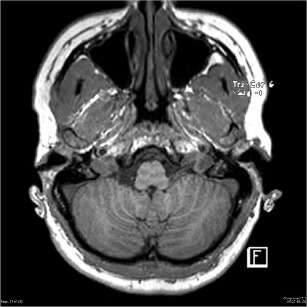 File:Cavernous malformation (cavernous angioma or cavernoma) (Radiopaedia 36675-38237 Axial T1 16).jpg