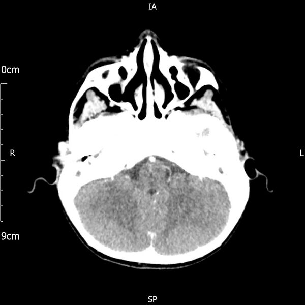 File:Cavernous sinus thrombosis (Radiopaedia 79414-92510 Axial Brain 64).jpg