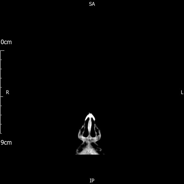 File:Cavernous sinus thrombosis (Radiopaedia 79414-92510 Coronal Brain 7).jpg