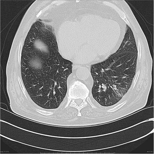 File:Cavitating left lower lobe lesion - squamous cell lung cancer (Radiopaedia 27749-28176 Axial lung window 37).jpg