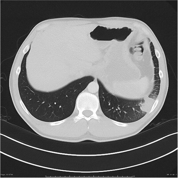 File:Cavitating lung cancer (Radiopaedia 25796-25945 Axial lung window 53).jpg