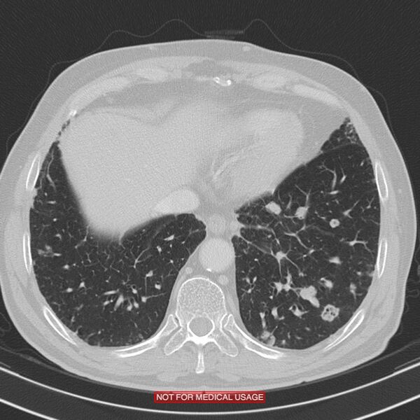File:Cavitating pulmonary metastases (Radiopaedia 24920-25184 Axial lung window 19).jpg