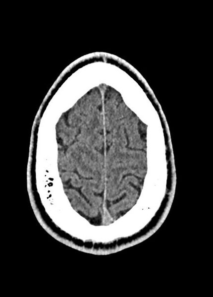 File:Cavum septum pellucidum and cavum vergae (Radiopaedia 77797-90060 Axial Brain Window 91).jpg