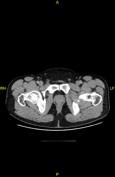 File:Cecal epiploic appendagitis (Radiopaedia 86047-102164 A 158).jpg