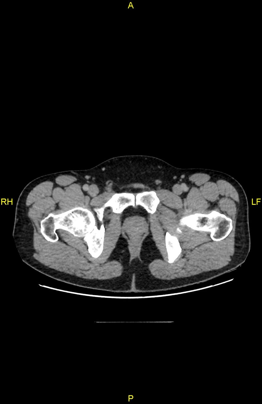 Cecal epiploic appendagitis (Radiopaedia 86047-102164 A 158).jpg