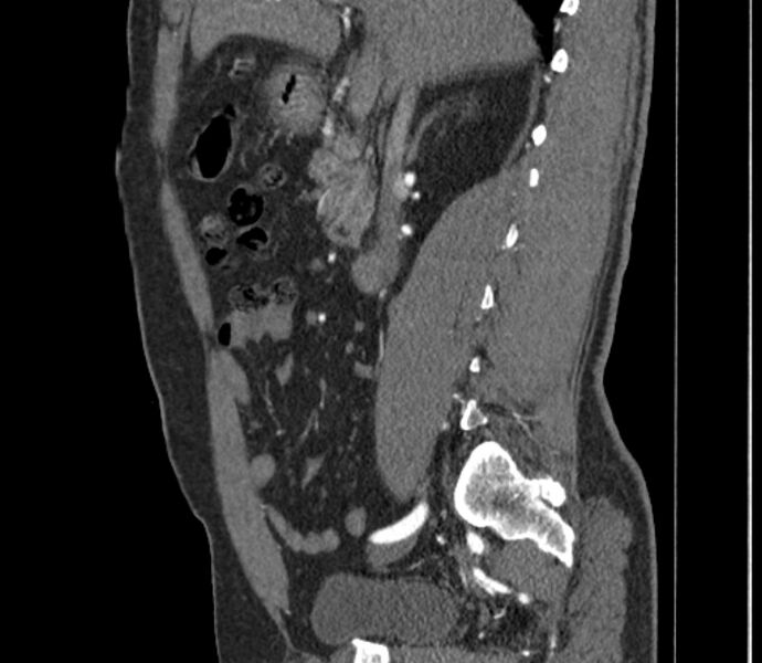 File:Celiac artery dissection (Radiopaedia 52194-58080 B 9).jpg