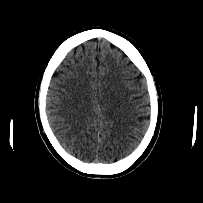 Central nervous system Langerhans cell histiocytosis (Radiopaedia 65728-74878 Axial non-contrast 36).jpg
