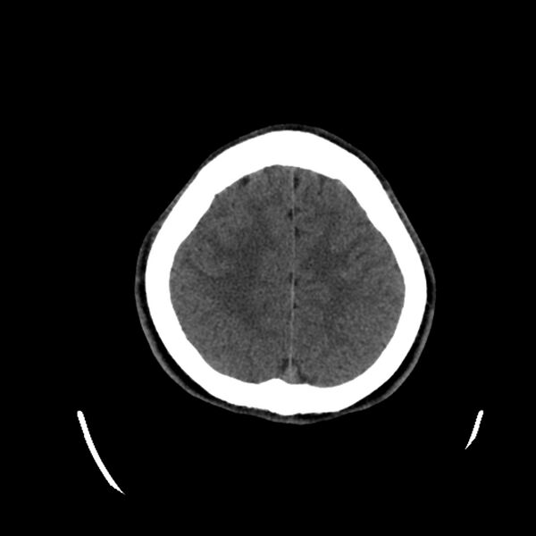 File:Central neurocytoma (Radiopaedia 79320-92379 Axial non-contrast 36).jpg