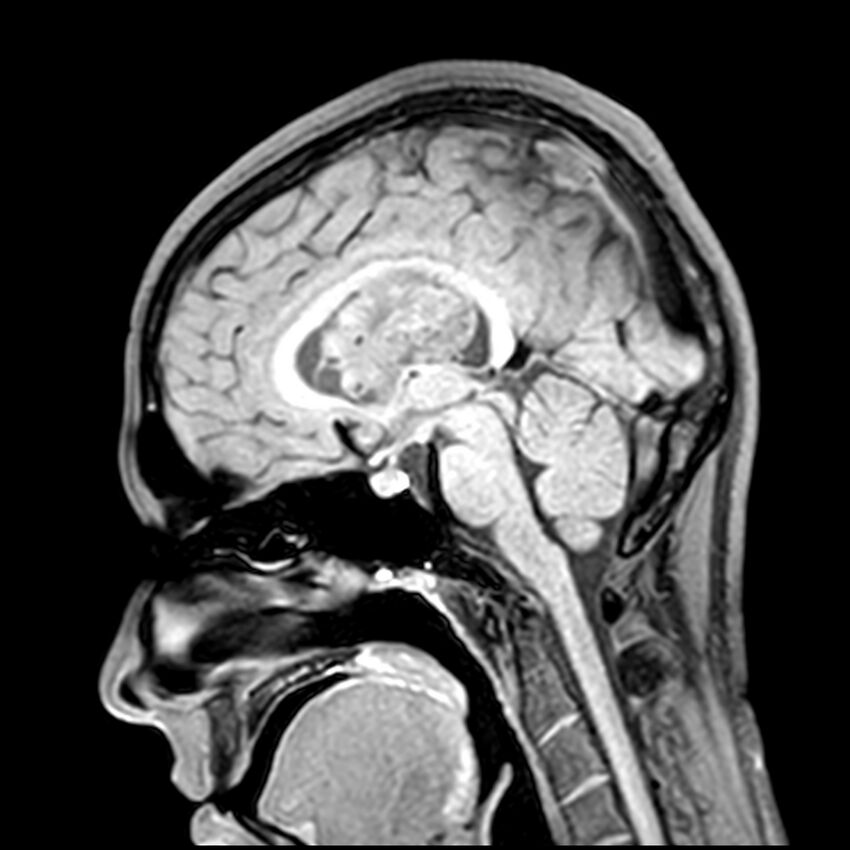 Central neurocytoma (Radiopaedia 79320-92380 Sagittal T1 133).jpg