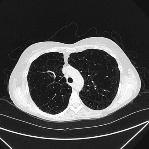 File:Centrilobular pulmonary emphysema (Radiopaedia 24495-24789 Axial lung window 31).jpg