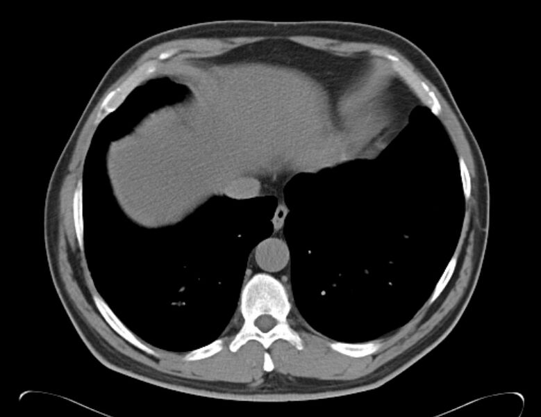 File:Centrilobular pulmonary emphysema (Radiopaedia 26808-26971 Axial non-contrast 35).jpg