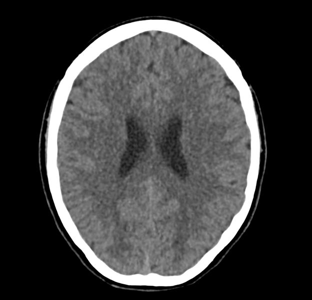 File:Cerebellar agenesis (Radiopaedia 30203-30817 Axial non-contrast 30).jpg