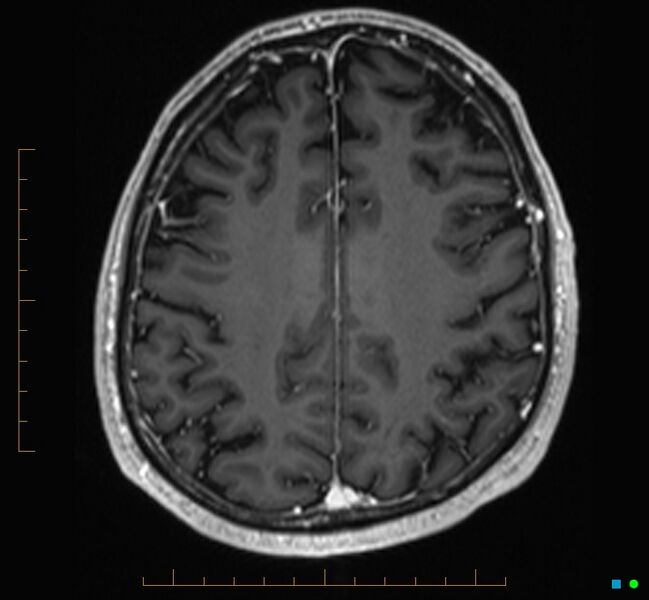 File:Cerebellar gangliocytoma (Radiopaedia 65377-74422 Axial T1 C+ 100).jpg
