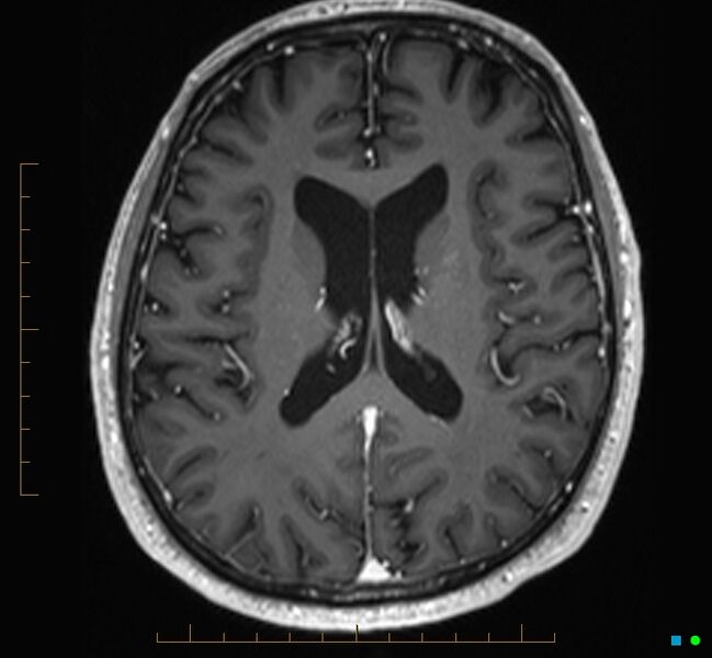 File:Cerebellar gangliocytoma (Radiopaedia 65377-74422 Axial T1 C+ 79).jpg