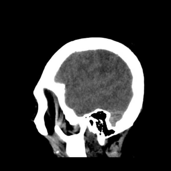 File:Cerebellar hemorrhage causing obstructive hydrocephalus (Radiopaedia 33989-35207 B 10).jpg