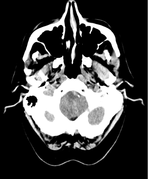 File:Cerebellar metastasis from lung adenocarcinoma (Radiopaedia 86690-102828 Axial non-contrast 4).png