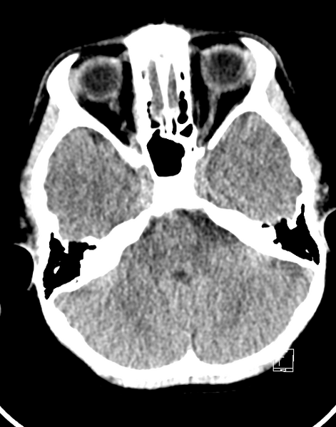 File:Cerebellar stroke (Radiopaedia 32202-33149 Axial non-contrast 4).png