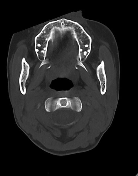 File:Cerebral abscesses (Radiopaedia 70458-80568 Axial bone window 5).jpg