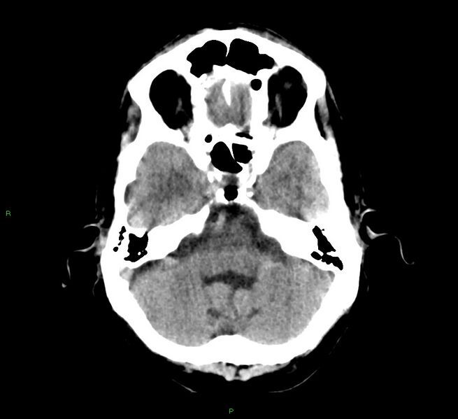 File:Cerebral amyloid angiopathy-associated lobar intracerebral hemorrhage (Radiopaedia 58529-65687 Axial non-contrast 39).jpg