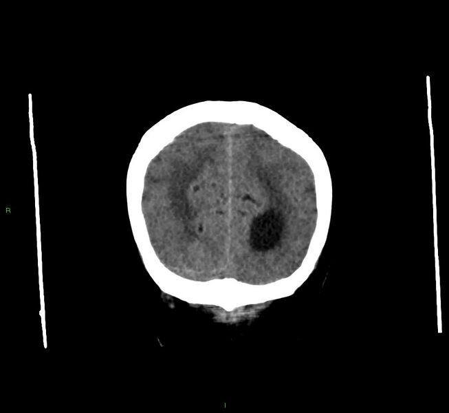 File:Cerebral amyloid angiopathy-associated lobar intracerebral hemorrhage (Radiopaedia 58560-65723 Coronal non-contrast 13).jpg