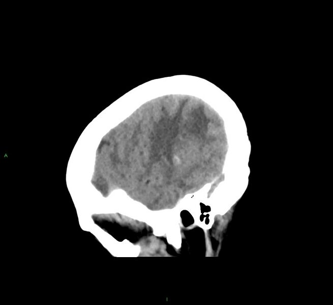 File:Cerebral amyloid angiopathy-associated lobar intracerebral hemorrhage (Radiopaedia 58563-65727 C 11).jpg