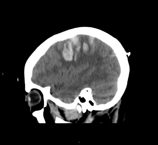 File:Cerebral amyloid angiopathy-associated lobar intracerebral hemorrhage (Radiopaedia 58566-65730 C 12).jpg