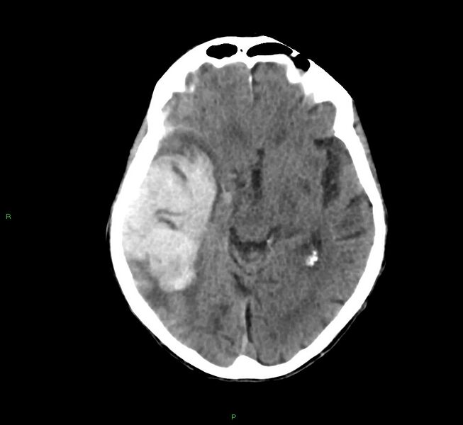 File:Cerebral amyloid angiopathy-associated lobar intracerebral hemorrhage (Radiopaedia 58758-65980 Axial non-contrast 29).jpg