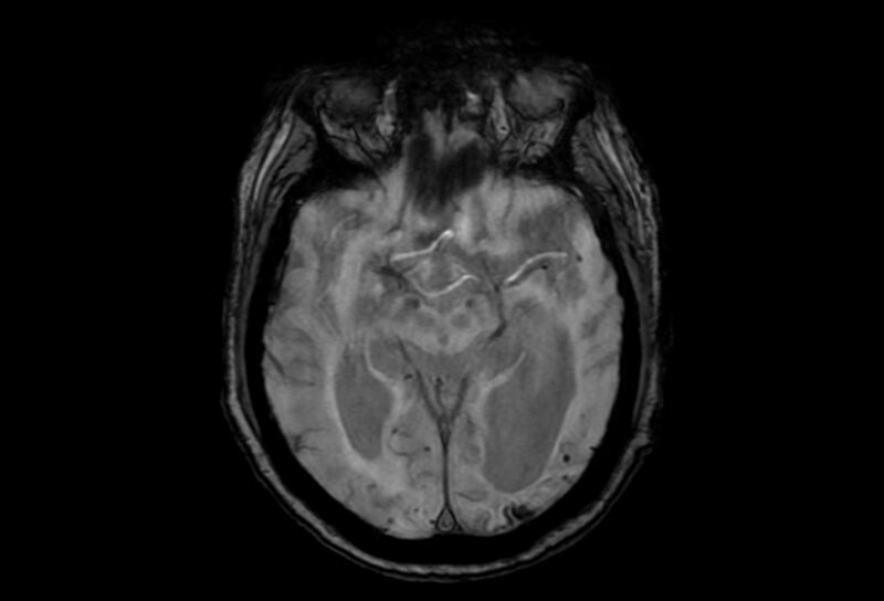 File:Cerebral amyloid angiopathy (Radiopaedia 86671-102792 Axial Gradient Echo 32).jpg