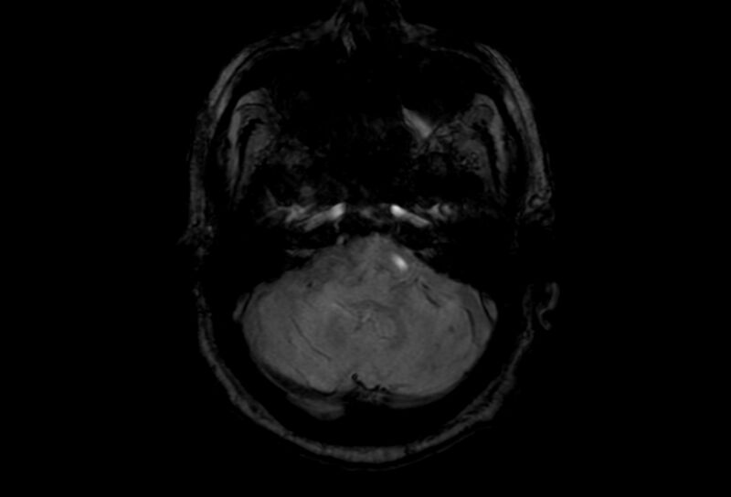 File:Cerebral amyloid angiopathy (Radiopaedia 86671-102792 Axial Gradient Echo 45).jpg