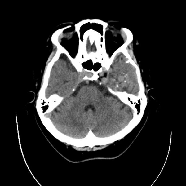 File:Cerebral arteriovenous malformation (Radiopaedia 43729-47189 Axial non-contrast 10).jpg
