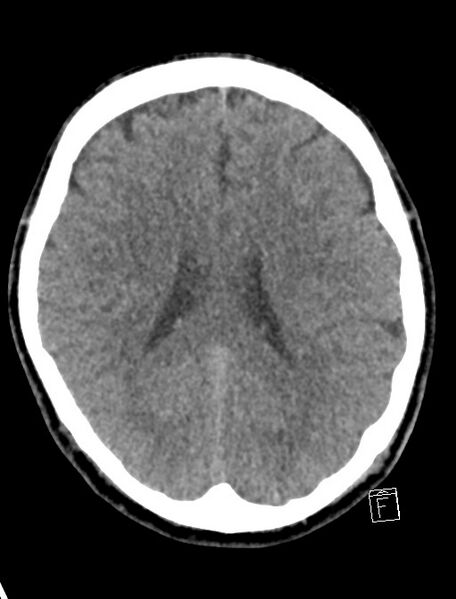 File:Cerebral arteriovenous malformation (Radiopaedia 78188-90745 Axial non-contrast 15).jpg