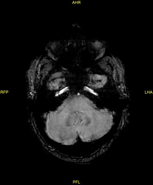 File:Cerebral autosomal dominant arteriopathy with subcortical infarcts and leukoencephalopathy (CADASIL) (Radiopaedia 86108-102054 Axial SWI 27).jpg