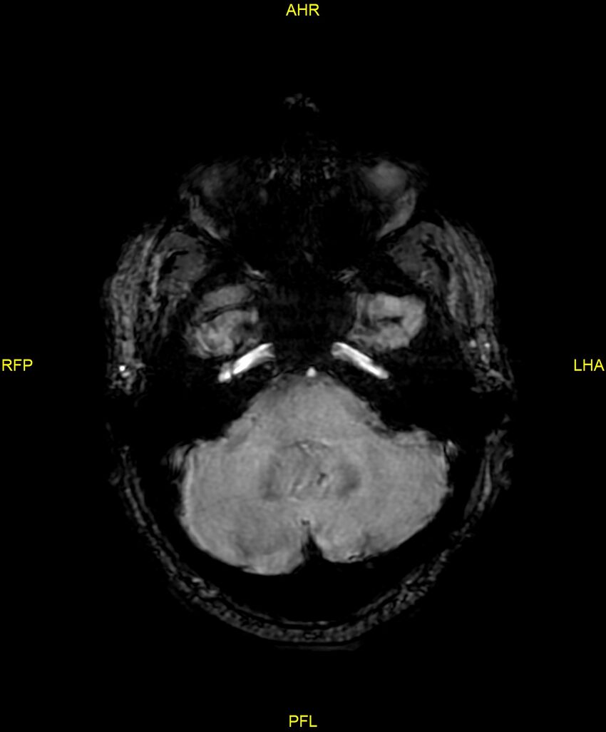 Cerebral autosomal dominant arteriopathy with subcortical infarcts and leukoencephalopathy (CADASIL) (Radiopaedia 86108-102054 Axial SWI 27).jpg