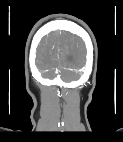 File:Cerebral dural venous sinus thrombosis (Radiopaedia 86514-102576 B 68).jpg
