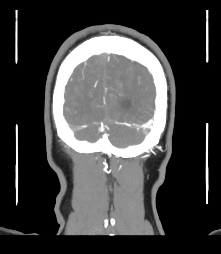 Cerebral dural venous sinus thrombosis (Radiopaedia 86514-102576 B 68).jpg