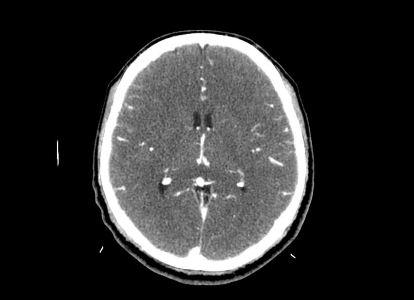 Cerebral edema (Radiopaedia 82519-96661 B 28).jpg