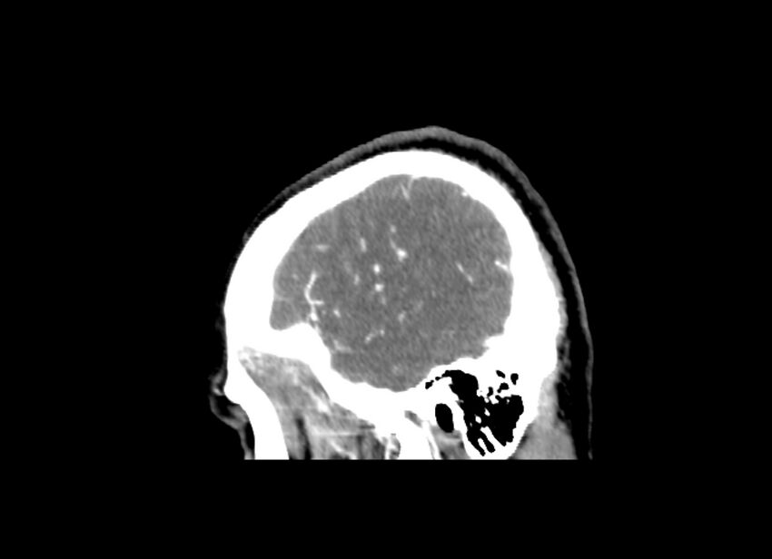 Cerebral edema (Radiopaedia 82519-96661 D 10).jpg